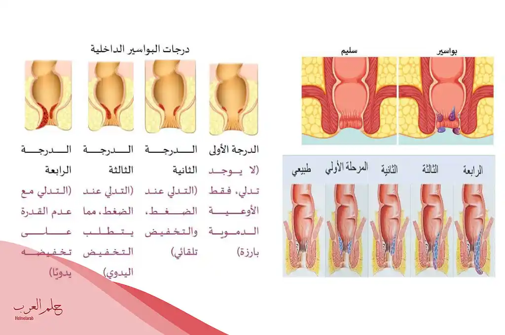 كيف أعالج البواسير في بدايته