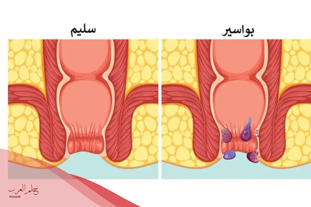 تليف بعد عملية البواسير