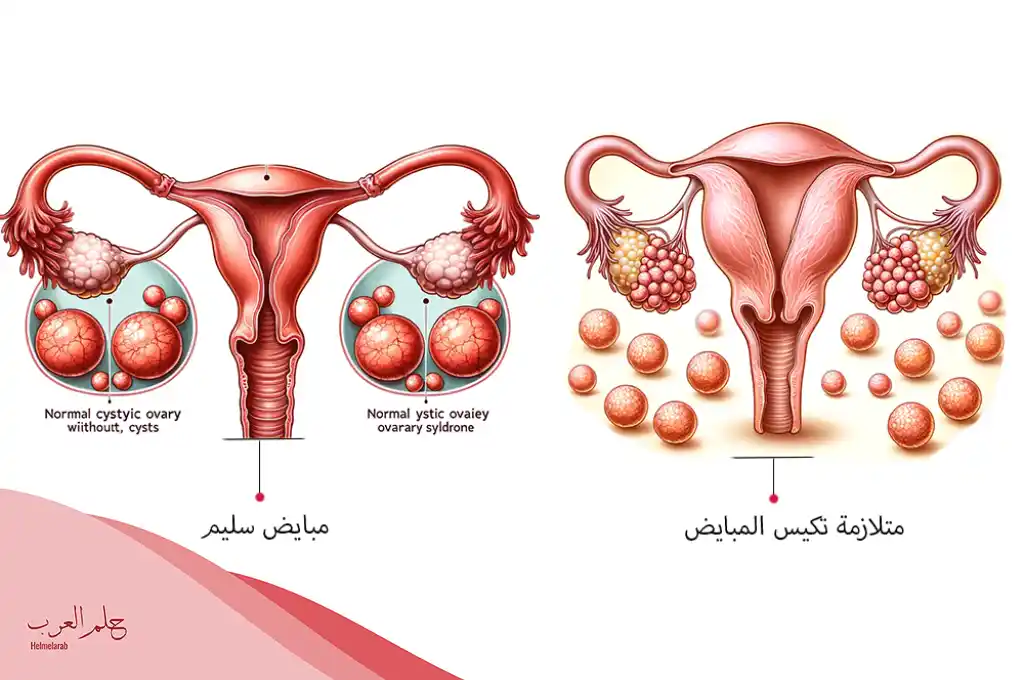 كيف اعرف ان الكيس على المبيض نزل وأنا حامل