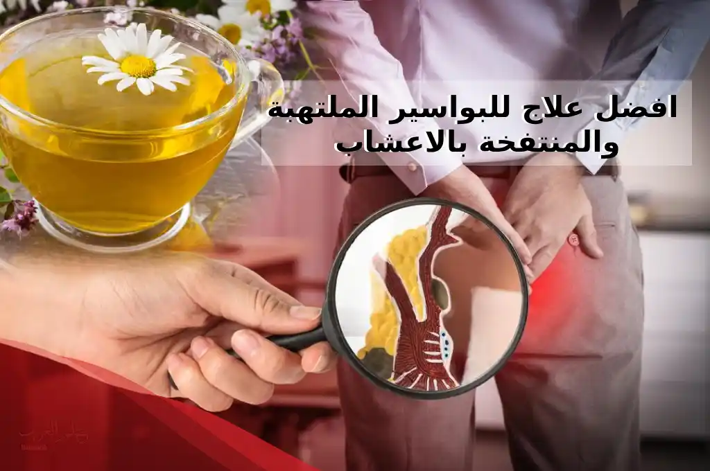 ماهو علاج البواسير الخارجية عند النساء