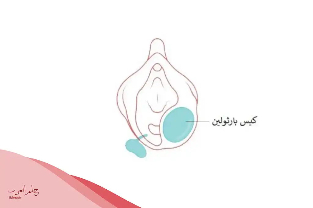 مرهم لعلاج غدة بارثولين