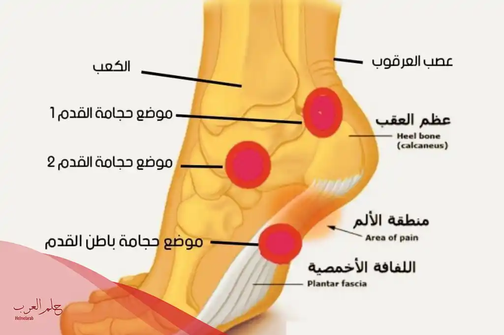 علاج التهاب اللفافة الأخمصية بالأعشاب